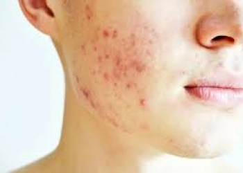 5 Cara Mudah untuk Mencegah Timbulnya Jerawat di Musim Dingin