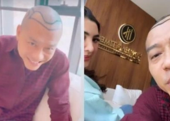 Anang Hermansyah: Seumur Hidup 2 Kali Botak Saat Lahiran dan Sekarang