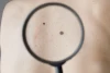 Ini Dia Perbedaan antara Tahi Lalat Normal dan Gejala Melanoma