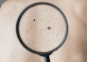 Ini Dia Perbedaan antara Tahi Lalat Normal dan Gejala Melanoma