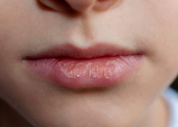 Cara Mudah Merawat Bibir Kering dan Pecah-pecah