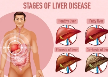 Masyarakat Diminta Waspada Terhadap Hepatitis Akut