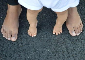 Penyebab dan Cara Mencegah Kaki O Pada Bayi 