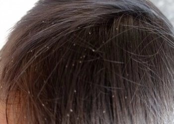 Hilangkan Kutu Rambut dengan Mouth Wash