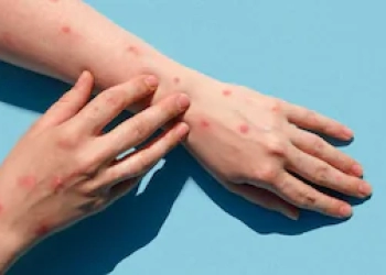 Monkeypox, Tidak Ada Alasan untuk Panik