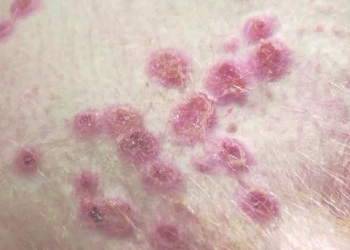 Virus Cacar Monyet Terdeteksi di 23 Negara dan Lebih dari 250 Kasus