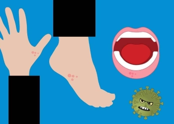 Flu Tomat Sebuah Virus Langka yang Menyerang Anak-anak